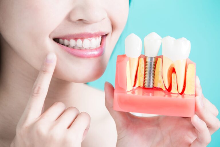 Dental Implants and Oral Hygiene Maintenance 